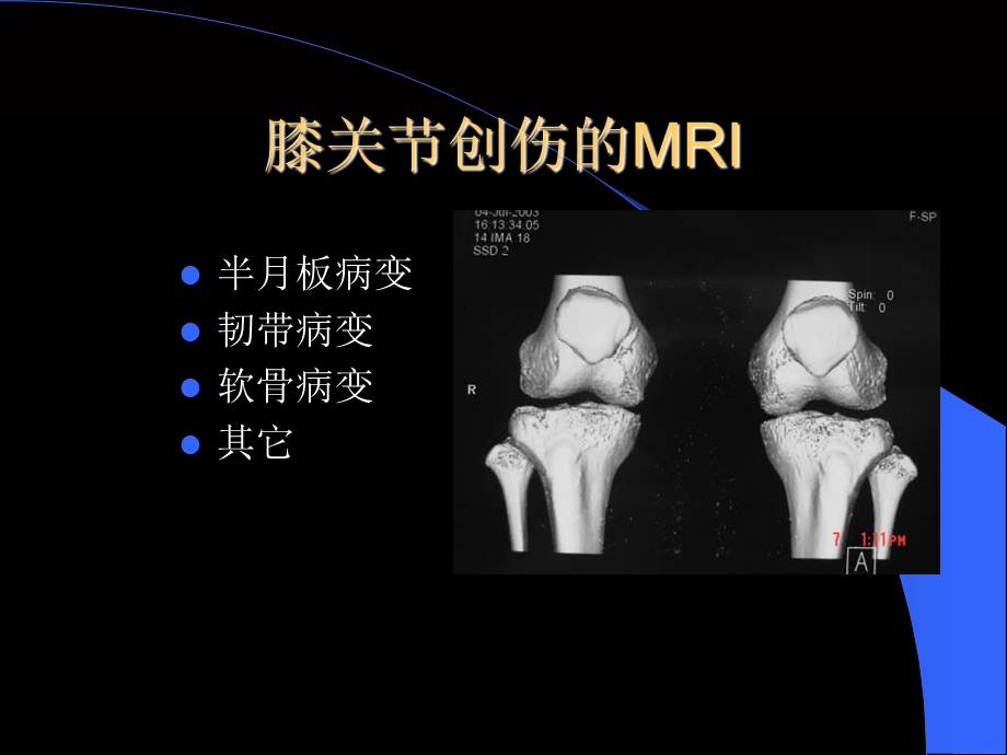 MRI在膝关节创伤的应用.ppt_第2页