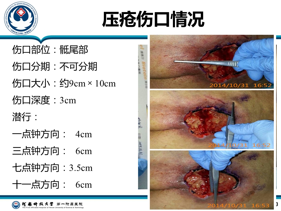 《压疮病例汇报》PPT课件.ppt_第3页