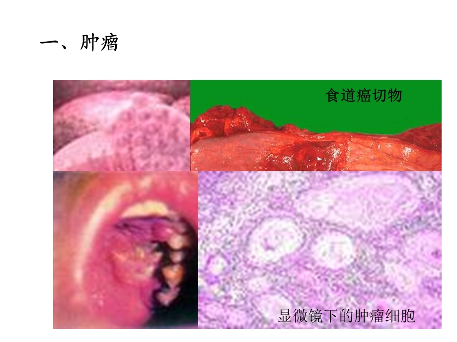 《肿瘤和冠心病》PPT课件.ppt_第2页