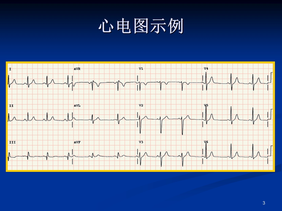 张琼玉正常心电图和.ppt_第3页