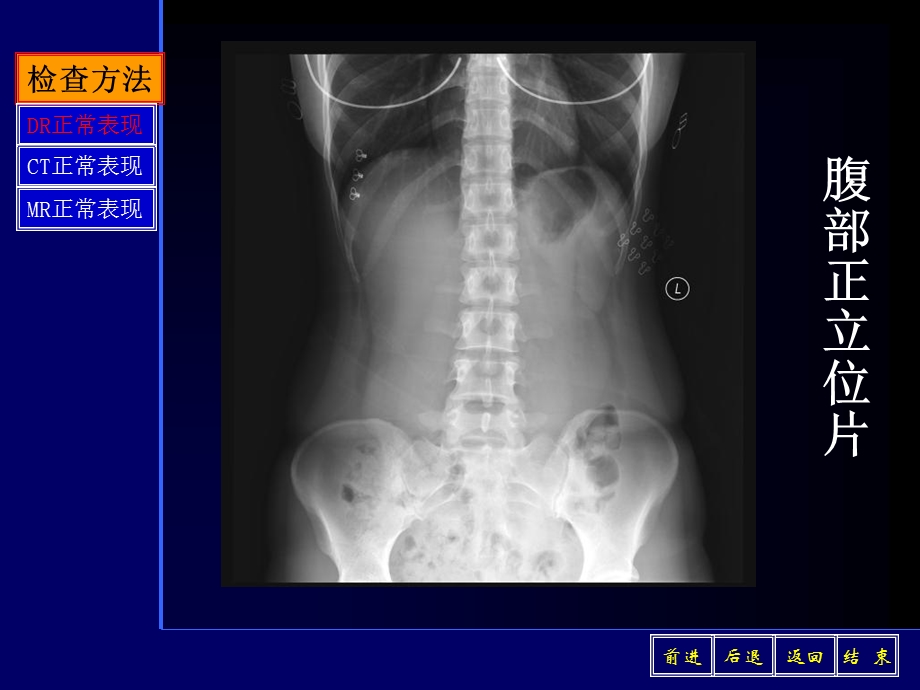 《腹部影像诊断》PPT课件.ppt_第3页