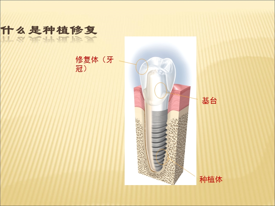 《口腔种植术》PPT课件.ppt_第2页