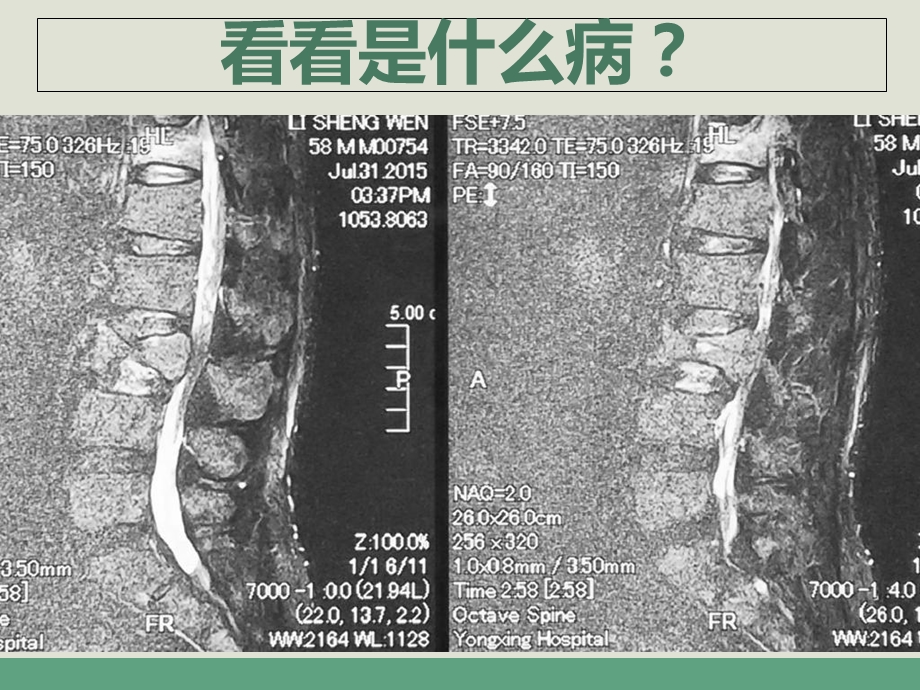 《脊柱骨髓瘤》PPT课件.ppt_第3页