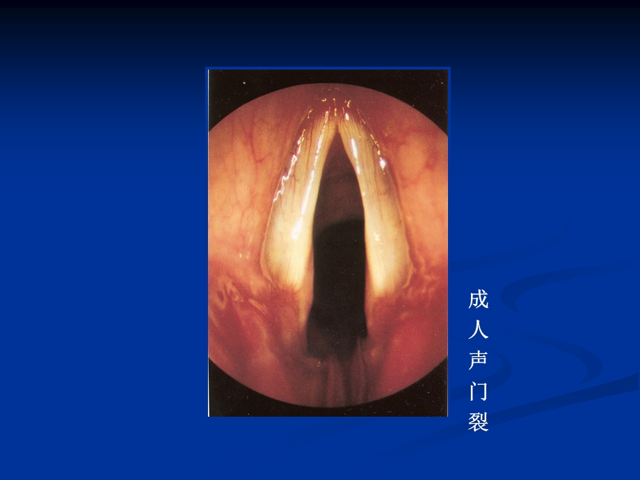 《间接喉镜检查》PPT课件.ppt_第3页