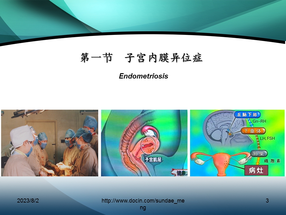 【大学课件】子宫内膜异位症、子宫腺肌病病人护理、妇产科常用护理技术.ppt_第3页