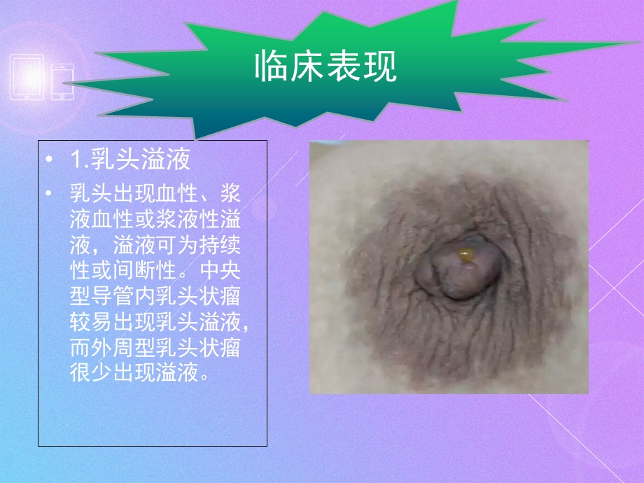 乳管内乳头状瘤相关知识.ppt_第3页