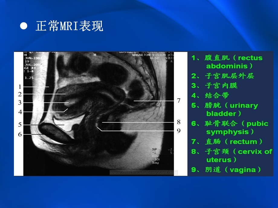 子宫内膜癌的MRI评价.ppt_第3页