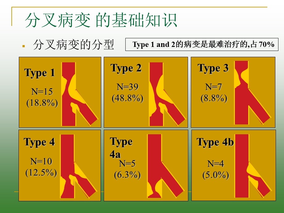 经桡动脉分叉病变的Kissing技巧.ppt_第3页