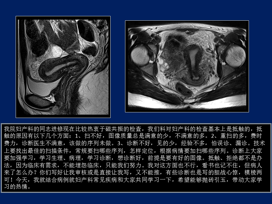 子宫MRI诊断课件.ppt_第2页