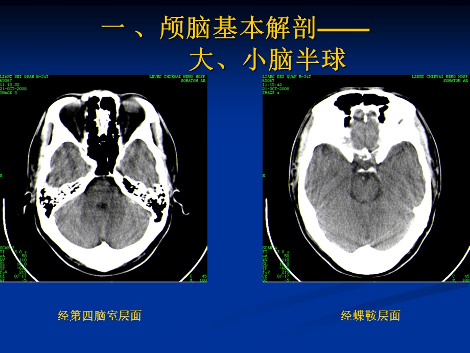 颅脑基本CT征象及颅脑外伤性疾病CT诊断.ppt_第2页