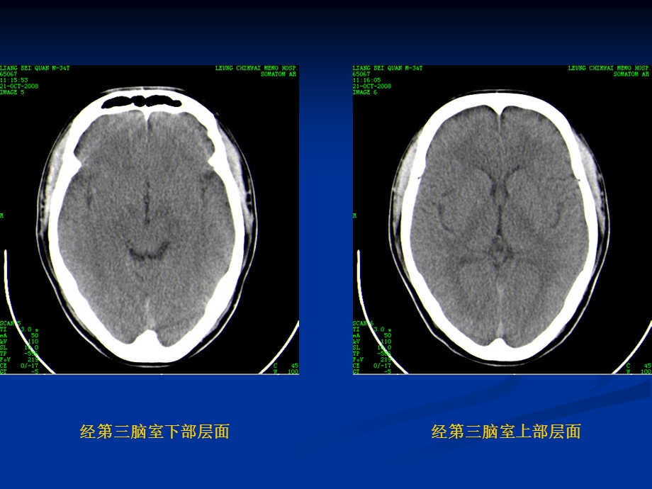 颅脑基本CT征象及颅脑外伤性疾病CT诊断.ppt_第3页