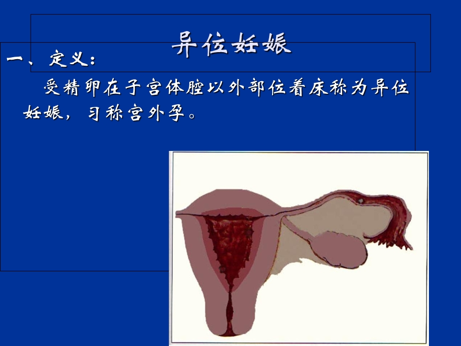 异位妊娠失血性休克的急救与护理.ppt_第3页