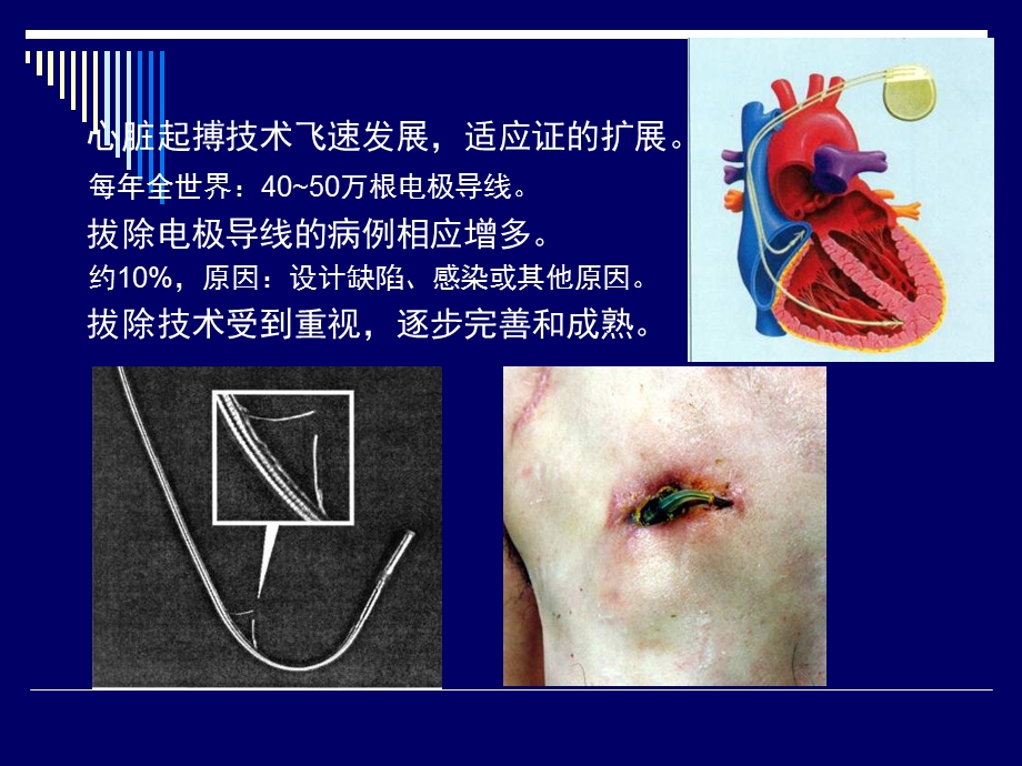 应用血管内反推力牵引技术拔除35根永久起搏电极导线.ppt_第3页