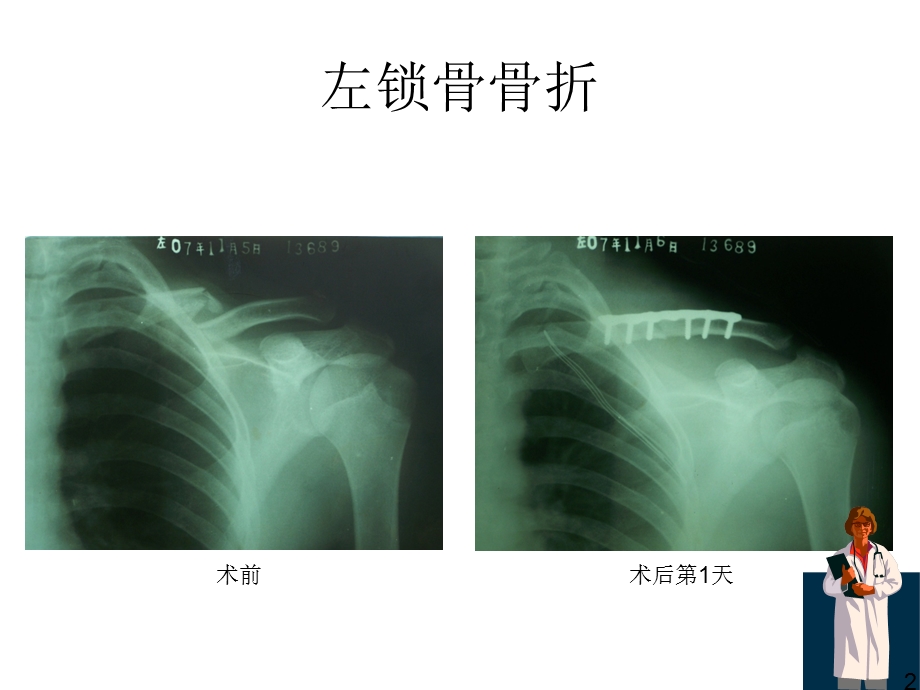 骨折x线片汇总ppt课件.ppt_第2页