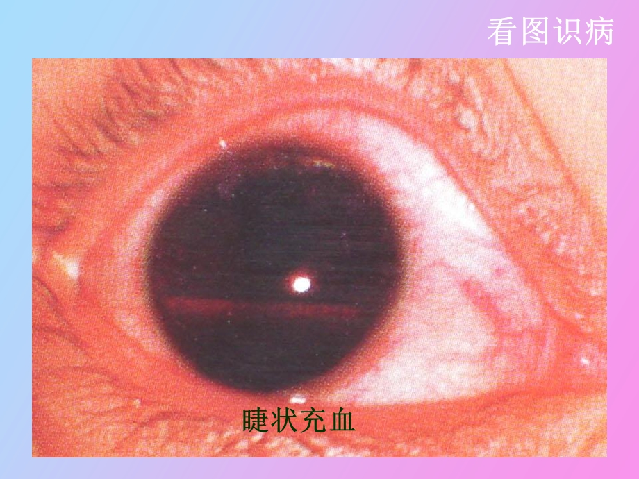 眼科常见疾病.ppt_第3页