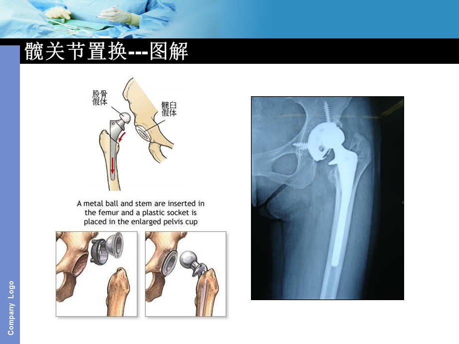 人工关节置换手术护理配合.ppt_第3页