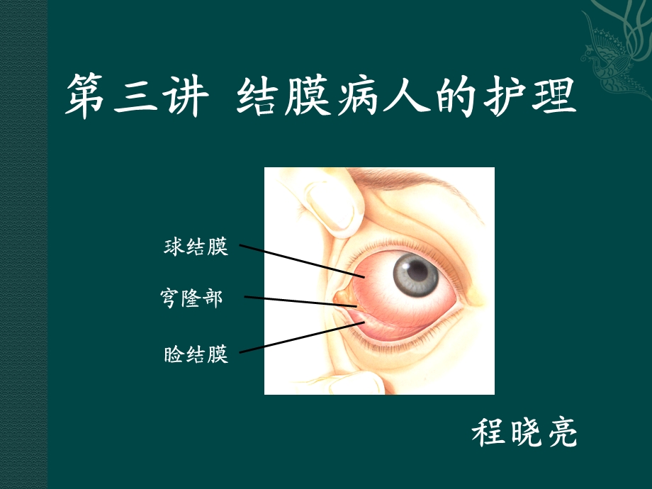 第三讲结膜病人的护理.ppt_第1页