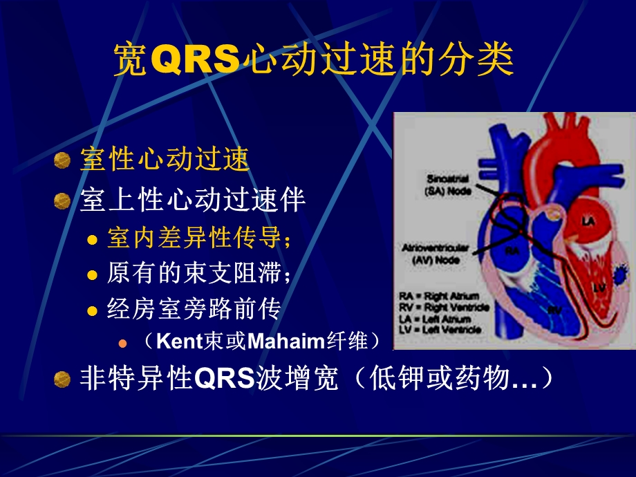 宽QRS波群心动过速.ppt_第3页