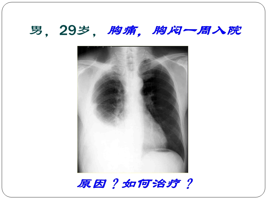 第十一章 胸腔积液 ppt课件.ppt_第1页