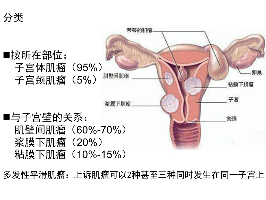 子宫平滑肌瘤文档资料.ppt_第2页
