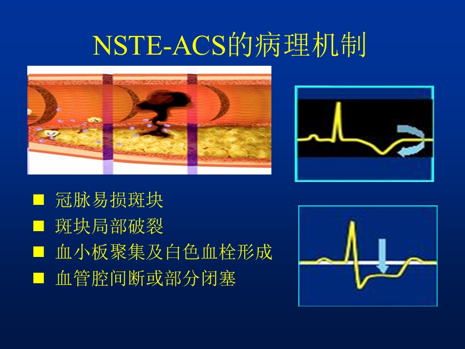 nsteacs多支血管病变靶血管的判定精选文档.ppt_第1页