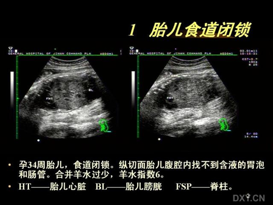 胎儿腹部畸形的超声诊断.ppt_第2页
