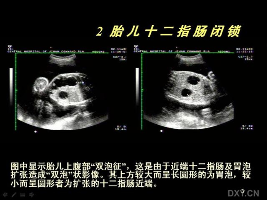 胎儿腹部畸形的超声诊断.ppt_第3页