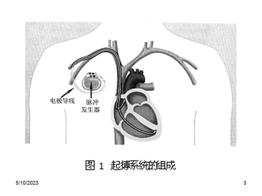 丁主任人工心脏起搏器与麻醉简版ppt课件.ppt_第3页