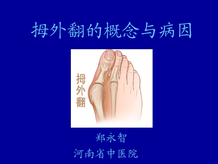 拇外翻的概念与病因ppt课件.ppt_第1页