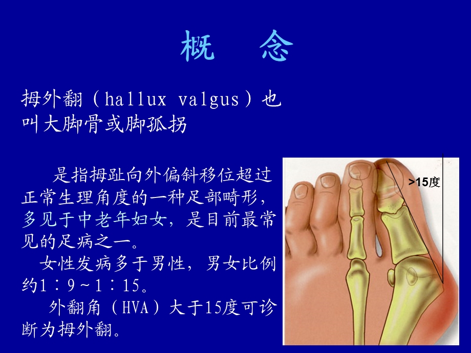 拇外翻的概念与病因ppt课件.ppt_第2页