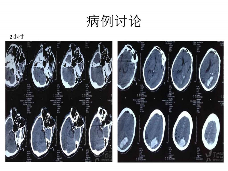 脑出血图文1504500973.ppt.ppt_第3页