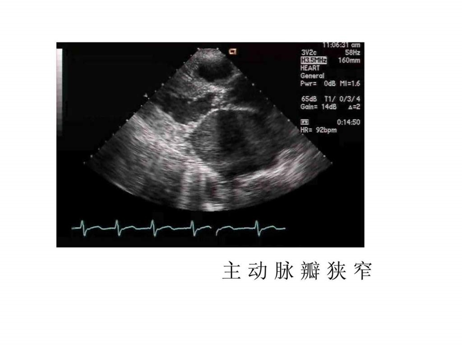 南昌大学超声精品课程之心脏瓣膜病之二.ppt_第1页