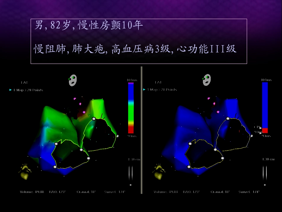 房颤导管消融的适应症.ppt_第3页