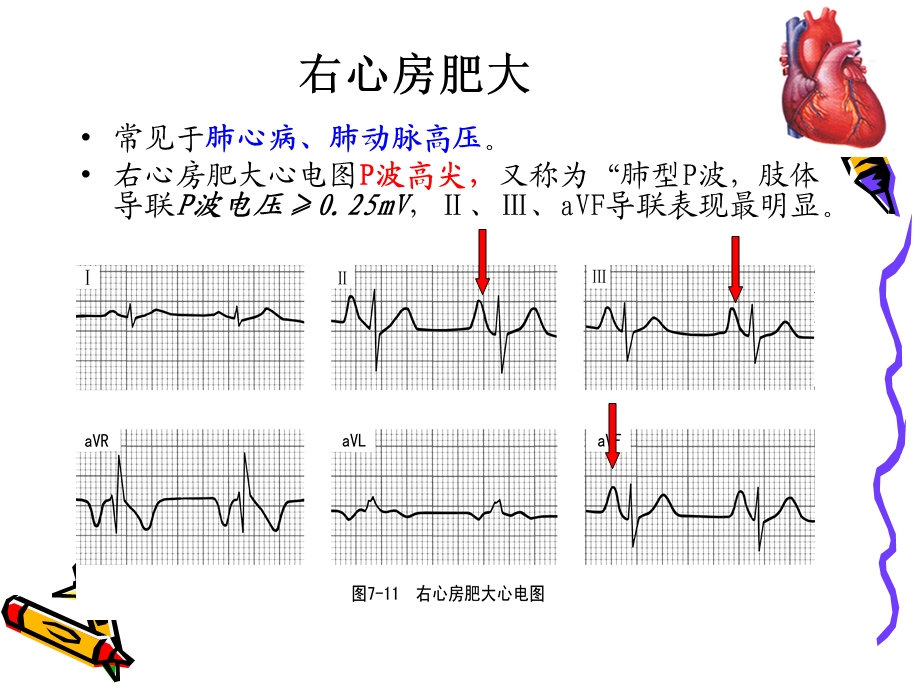 常见异常心电图.ppt_第3页