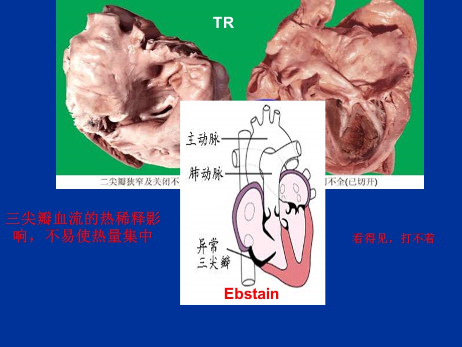 尖瓣环点钟大头到位技巧.ppt_第3页