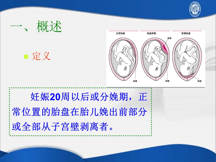 胎盘早剥Placentalabru.ppt_第2页