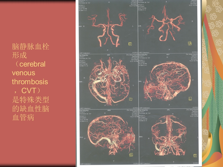 脑血栓形成的治疗.ppt_第2页