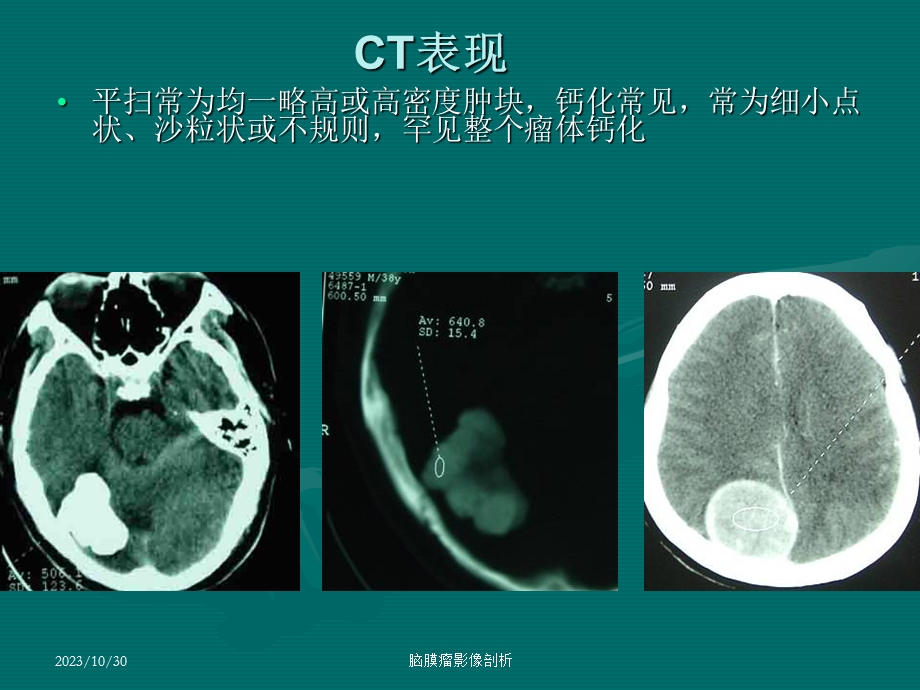 脑膜瘤ct表现.ppt_第3页