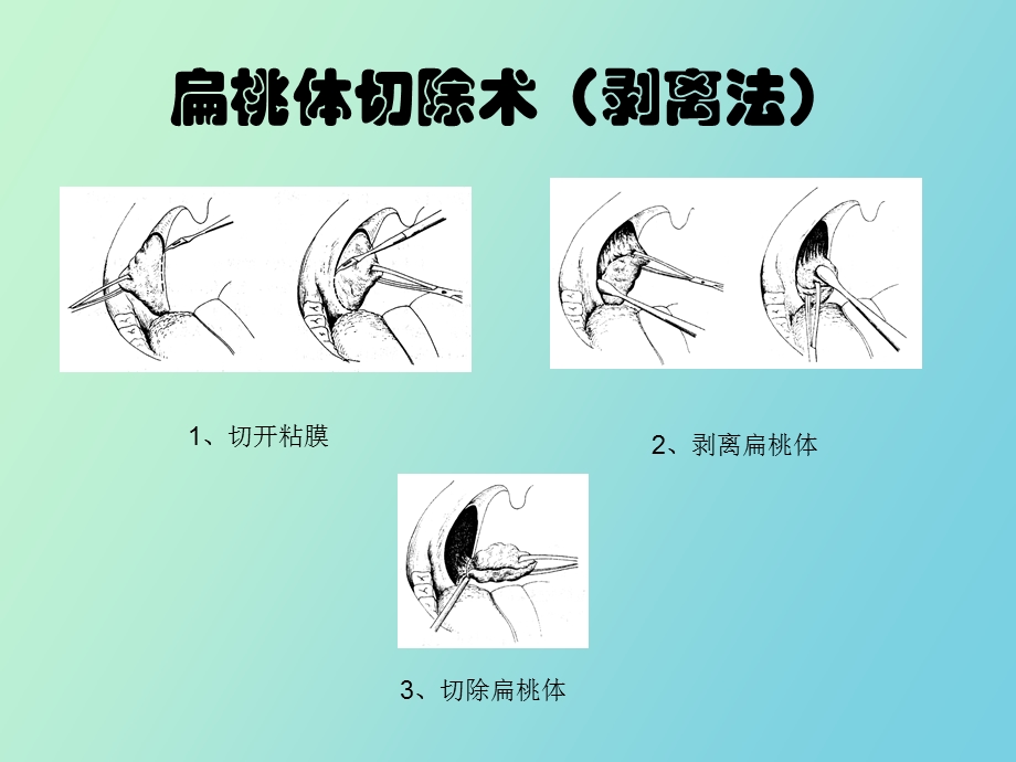 扁桃体切除术.ppt_第2页