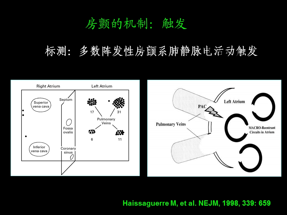 房颤的射频消融治疗教学课件.ppt_第3页