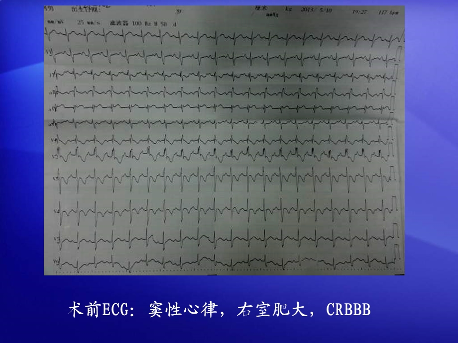 房缺封堵术后高度房室传导阻滞1例.ppt_第3页