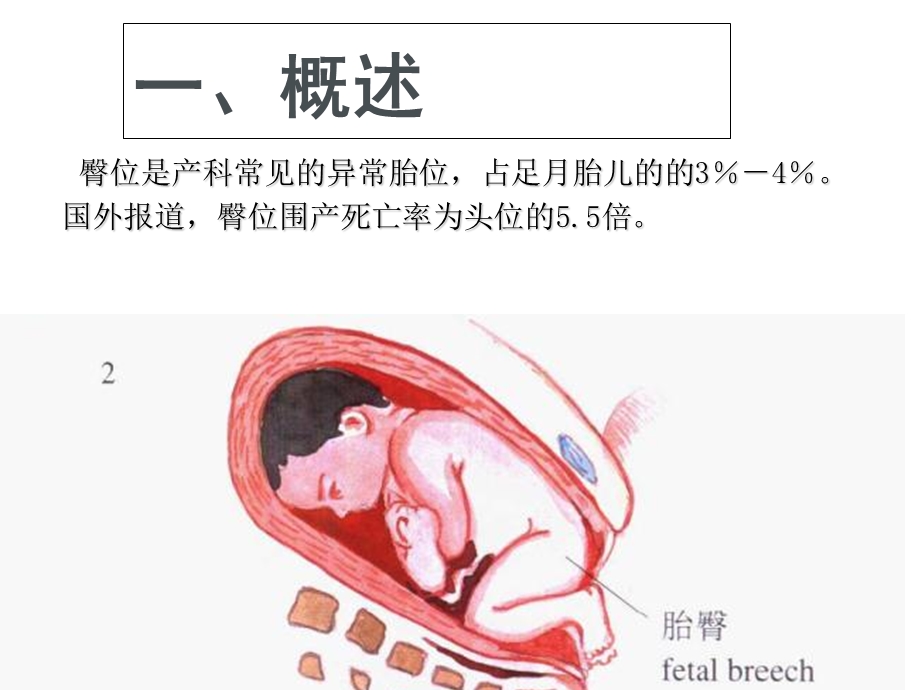 臀位分娩[1]_【PPT课件】.ppt_第2页
