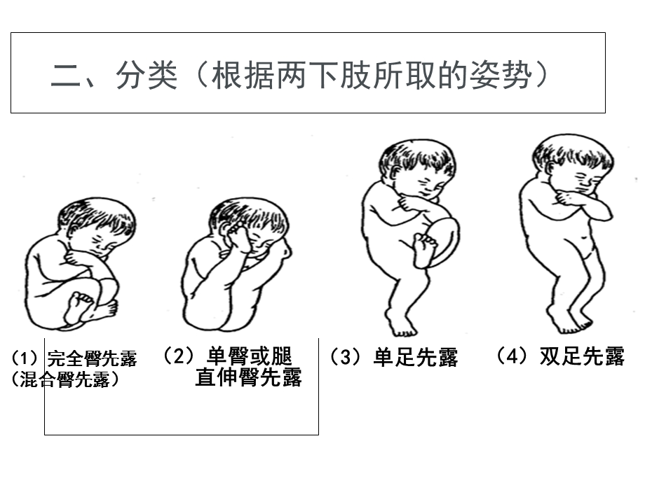 臀位分娩[1]_【PPT课件】.ppt_第3页