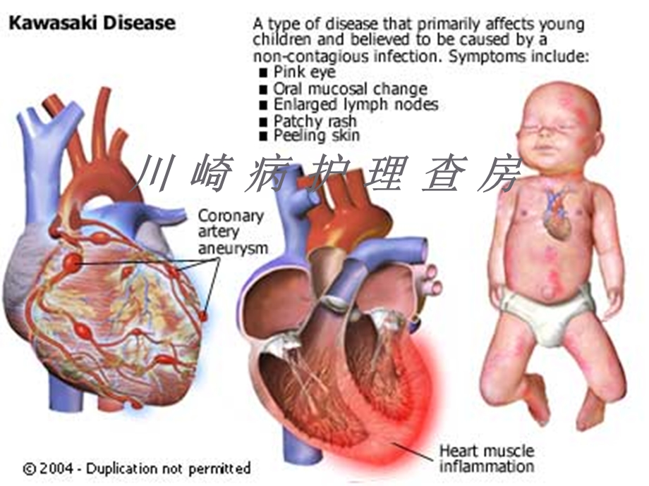 川崎病的护理查房医学ppt课件.ppt_第1页