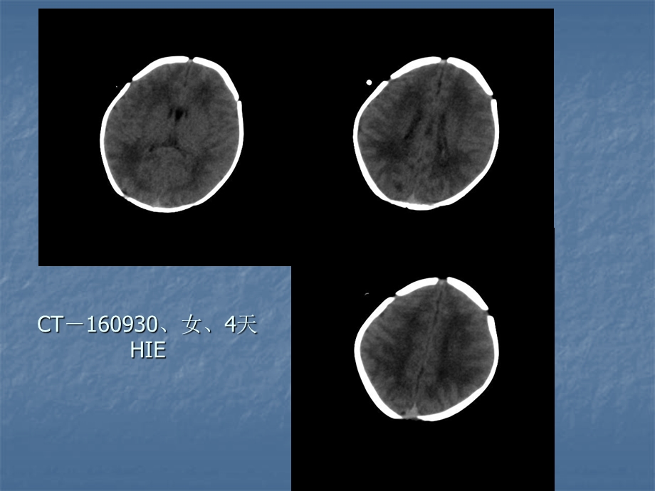 头部ct卫校讲课.ppt_第3页