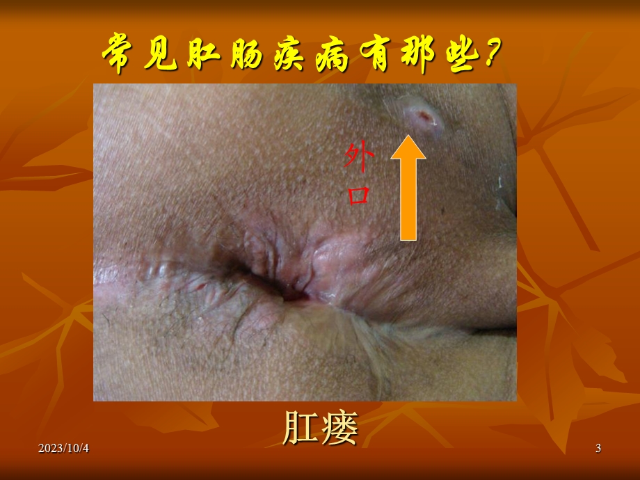 肛肠科科普知识宣讲.ppt_第3页