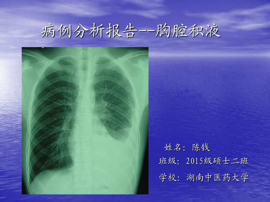 胸腔积液病例分析.ppt_第1页